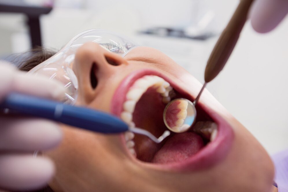 Dental Fillings