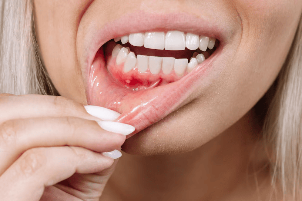 Gums Bleeding