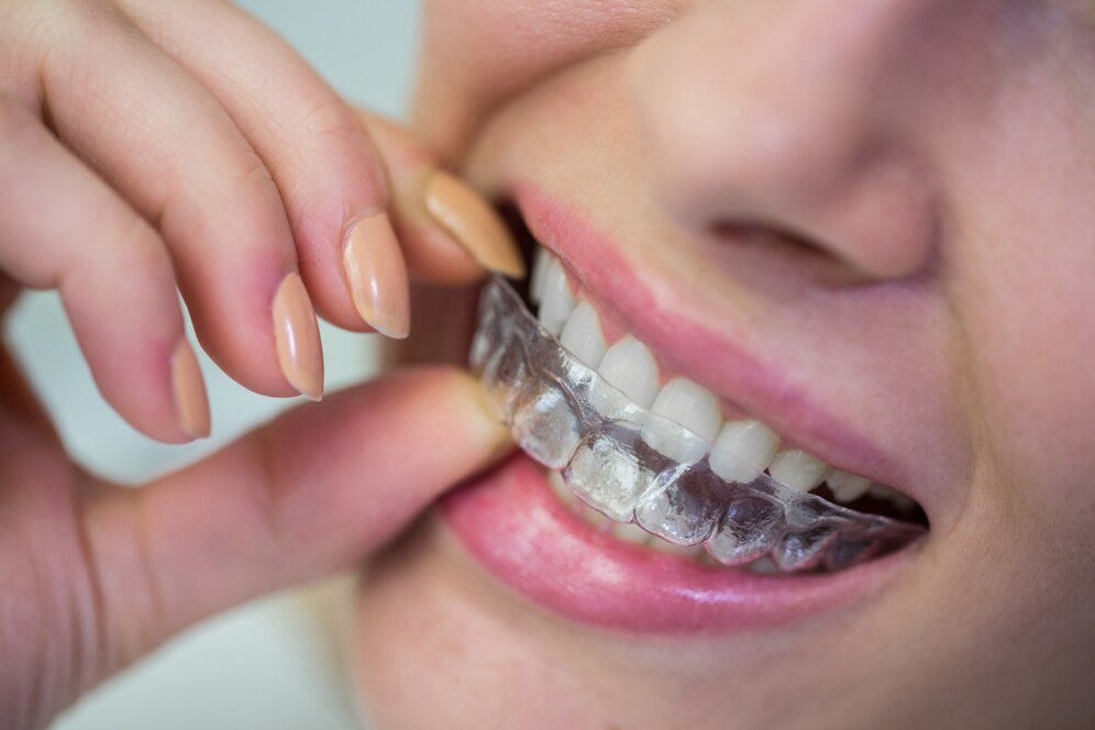 Teeth Braces & Aligners